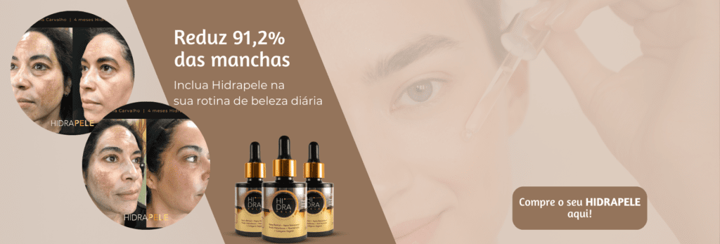 o que causa o melasma?