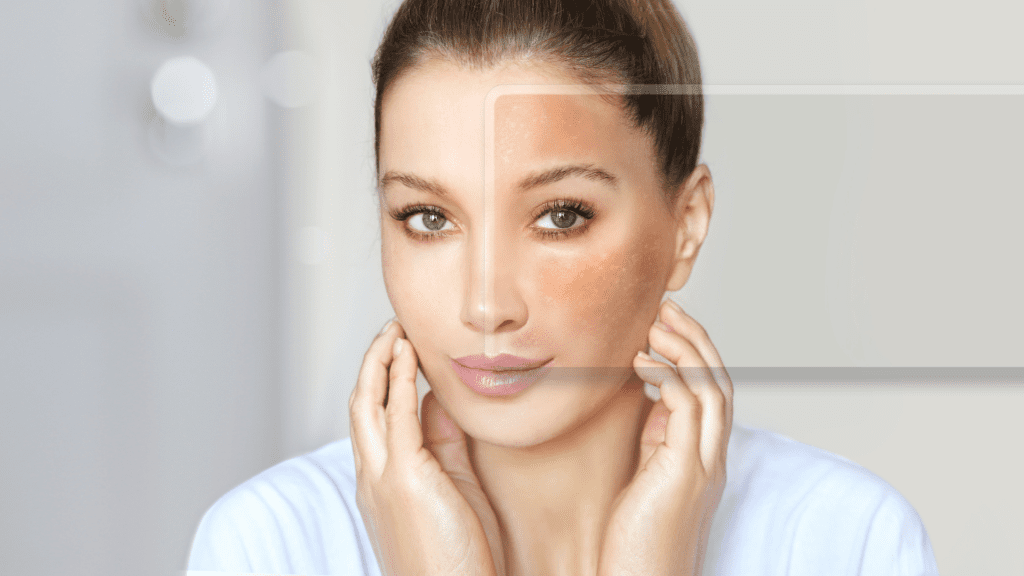 Melasma: o que é e como tratá-lo?